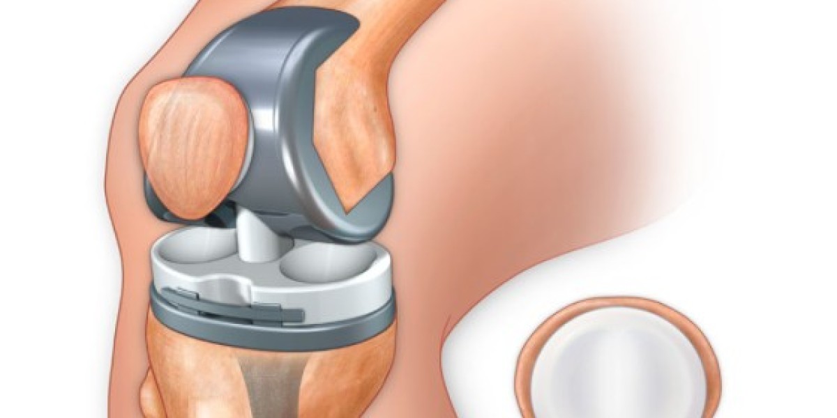 Knee Replacement in Lahore: Expert Care at Ortho Center Pakistan