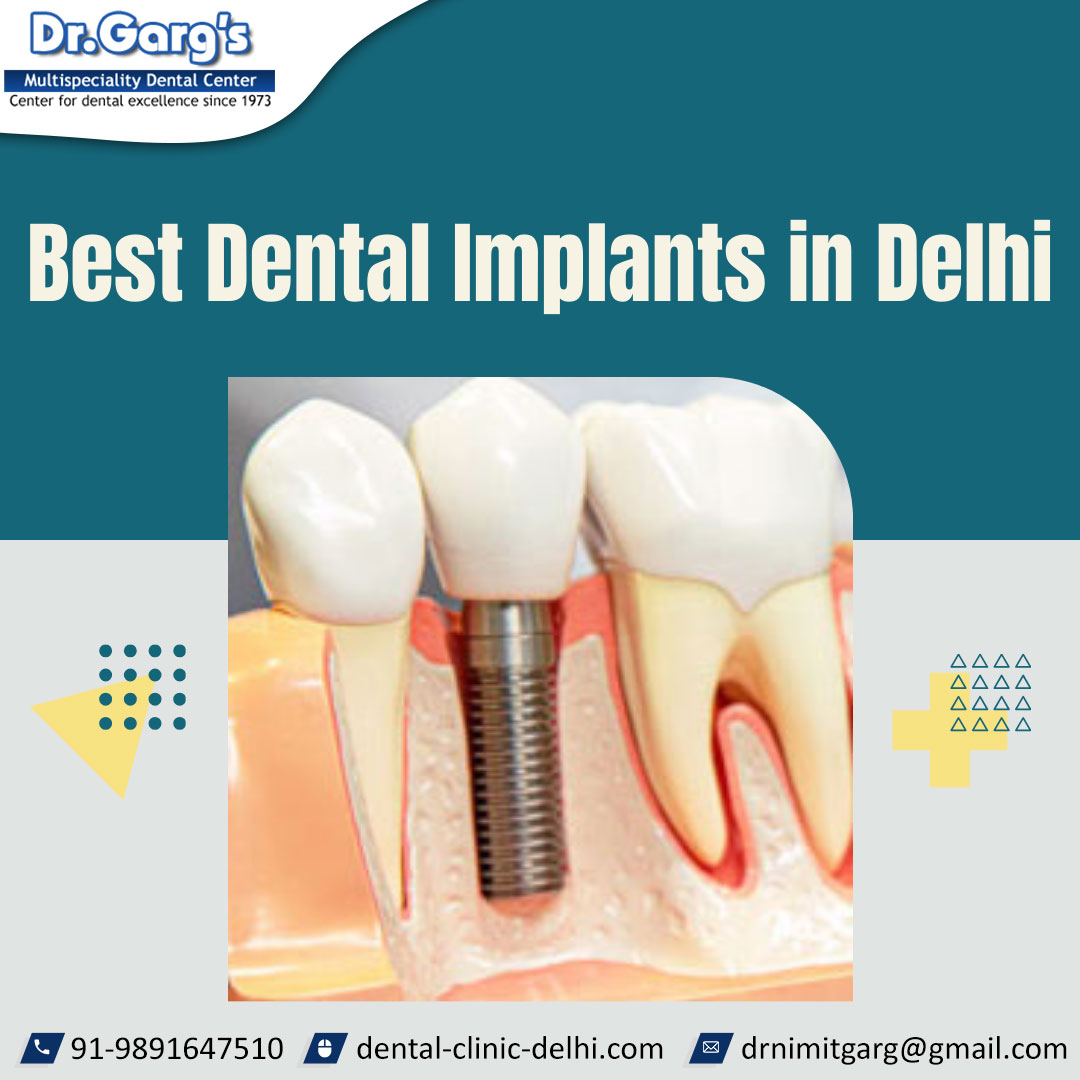 Best Dental Implants in Delhi hosted at ImgBB — ImgBB