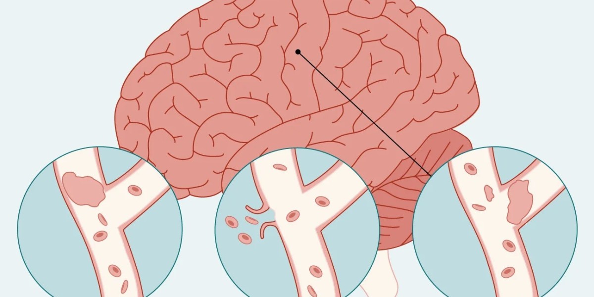 From Dizziness to Stroke: Managing Neurological Emergencies Effectively