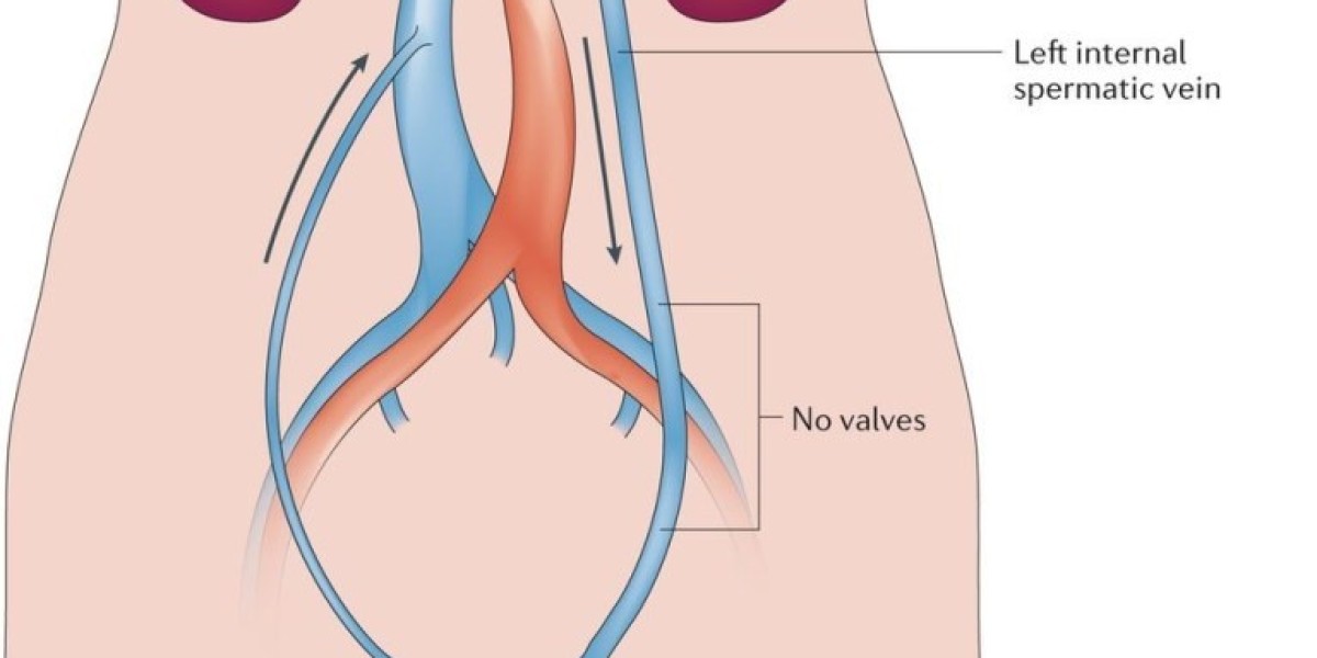 Effective Varicocele Embolisation: A Comprehensive Guide