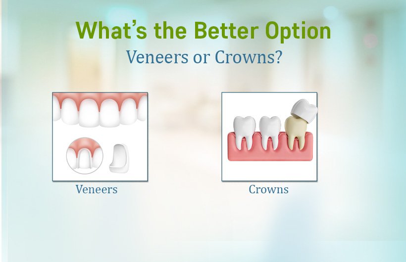 Veneers vs. Crowns: Which Is the Best Choice?