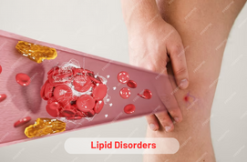 Lipid Disorders Treatment: Causes, Symptoms, Diagnosis & Management