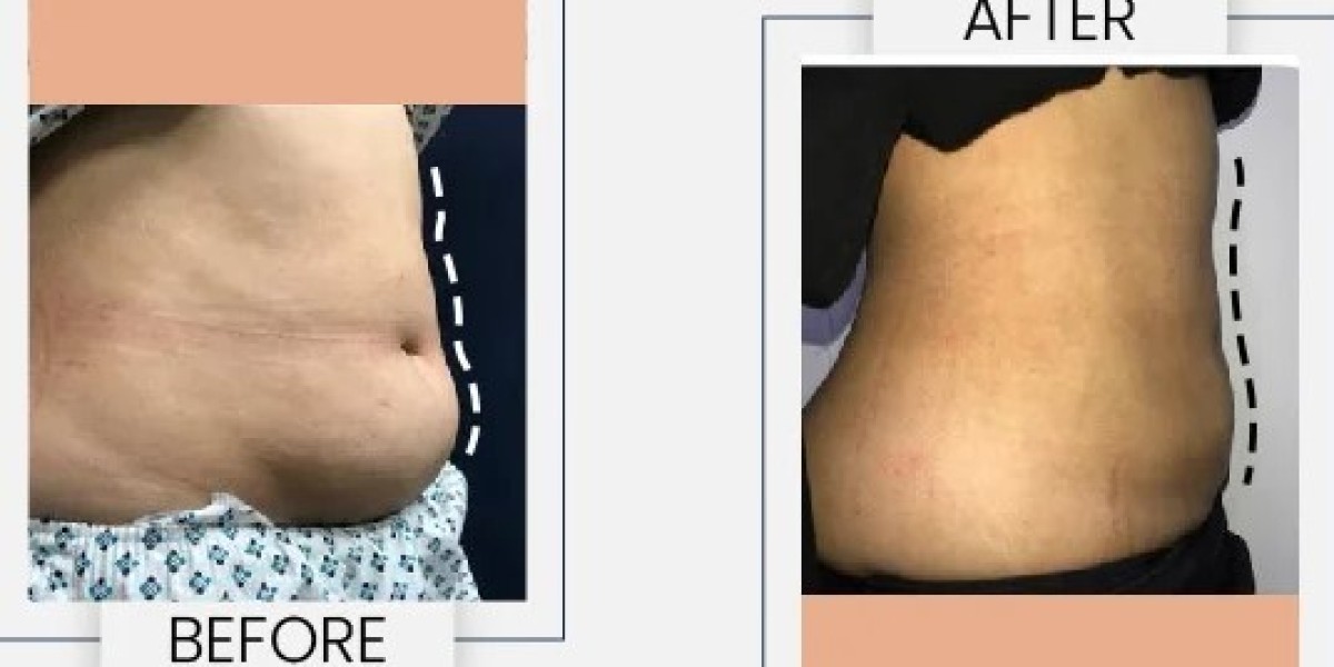 Liposuction in Lahore: Everything You Need to Know Before Surgery